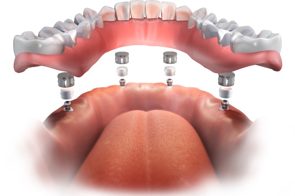 How Dentists Plan The All On   Procedure