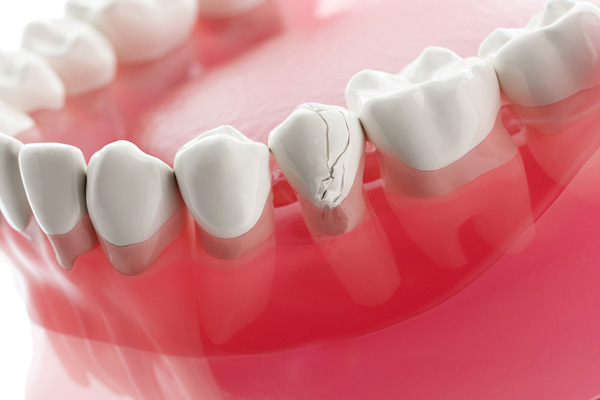 Dental Emergencies: What To Do For Broken Teeth