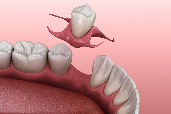 Partial Denture for One Missing Tooth: Can It be a Removable Denture? from Smiles Dental Spa in Tracy, CA