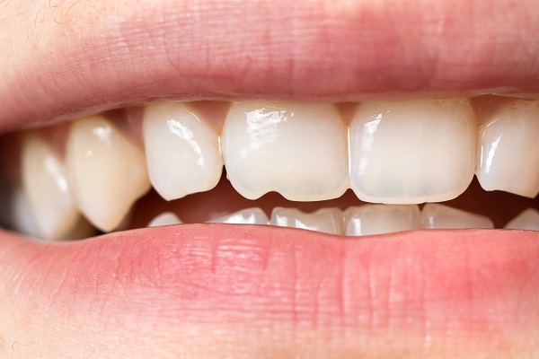 How A Dentist Can Treat A Chipped Tooth