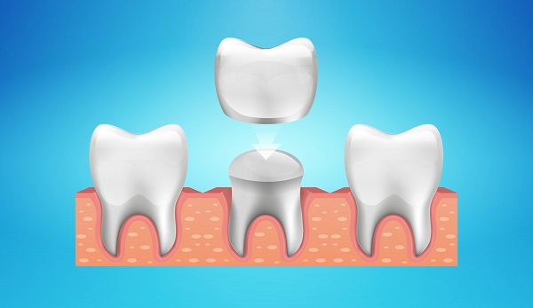 Common Dental Crown Solutions