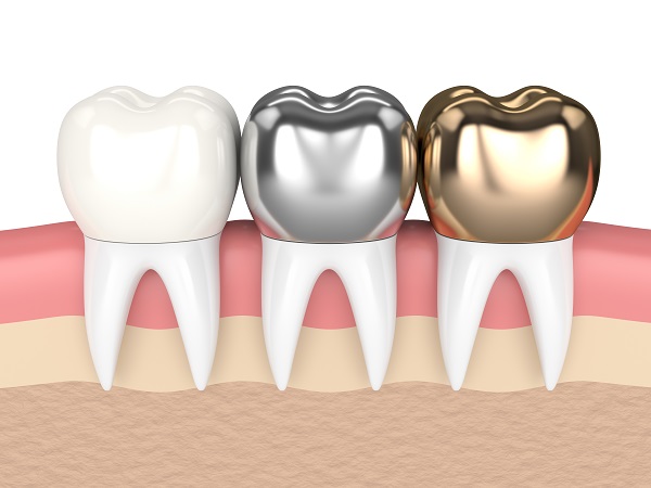 When A Dental Crown Is Necessary