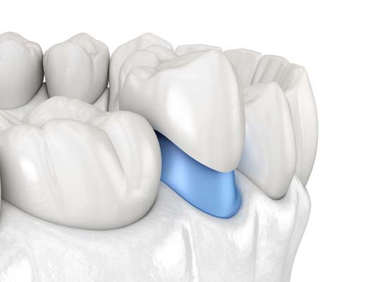 Damaged Tooth Repair With A Dental Crown