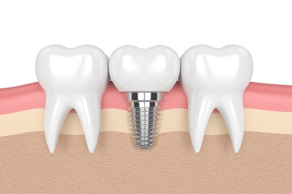 Dental Implants Tracy, CA