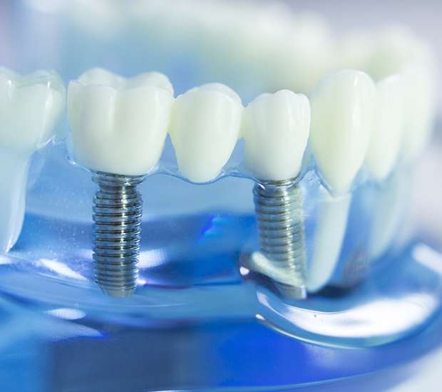 Tracy Dental Implants