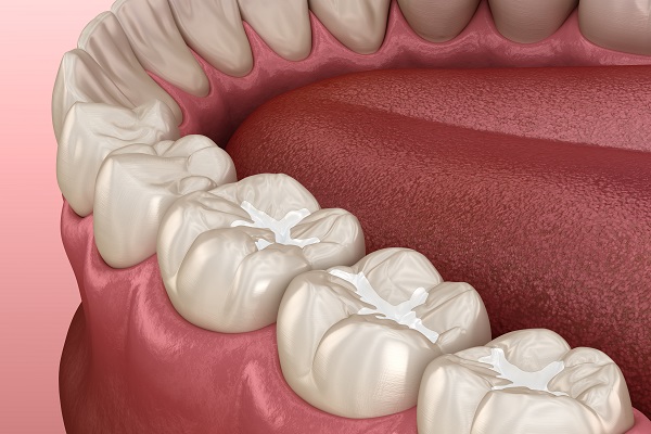 Preventive Benefits Of Dental Sealants