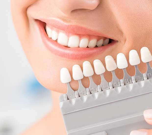 Tracy Dental Veneers and Dental Laminates