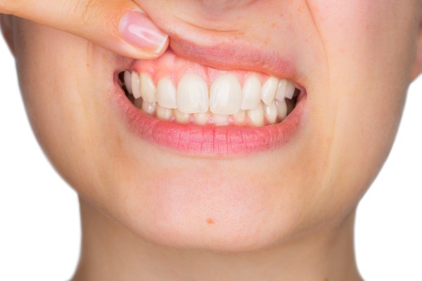 What You Should Know About Gum Disease