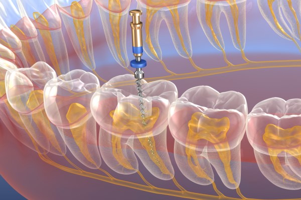 Relieving Pain With Root Canal Therapy