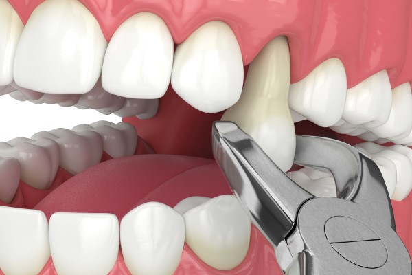 The Process Of Getting A Tooth Extraction