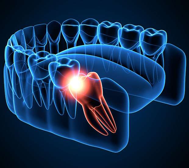 Tracy Wisdom Teeth Extraction